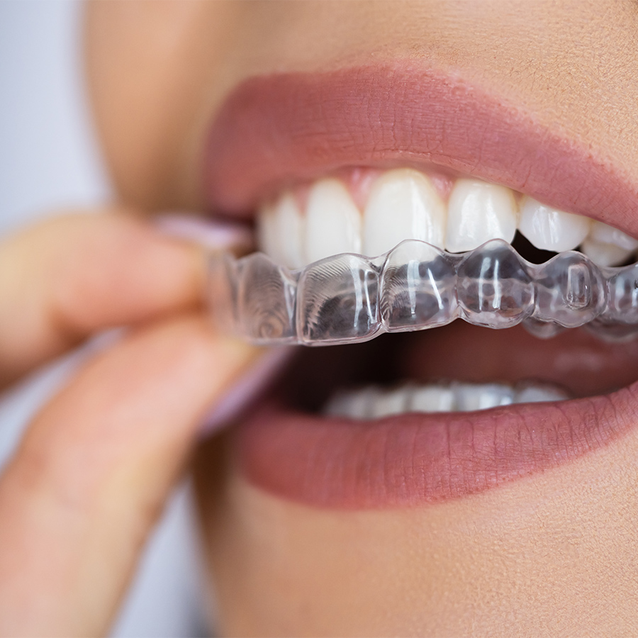 Unsichtbare Zahnkorrekturen mit Invisalign®
